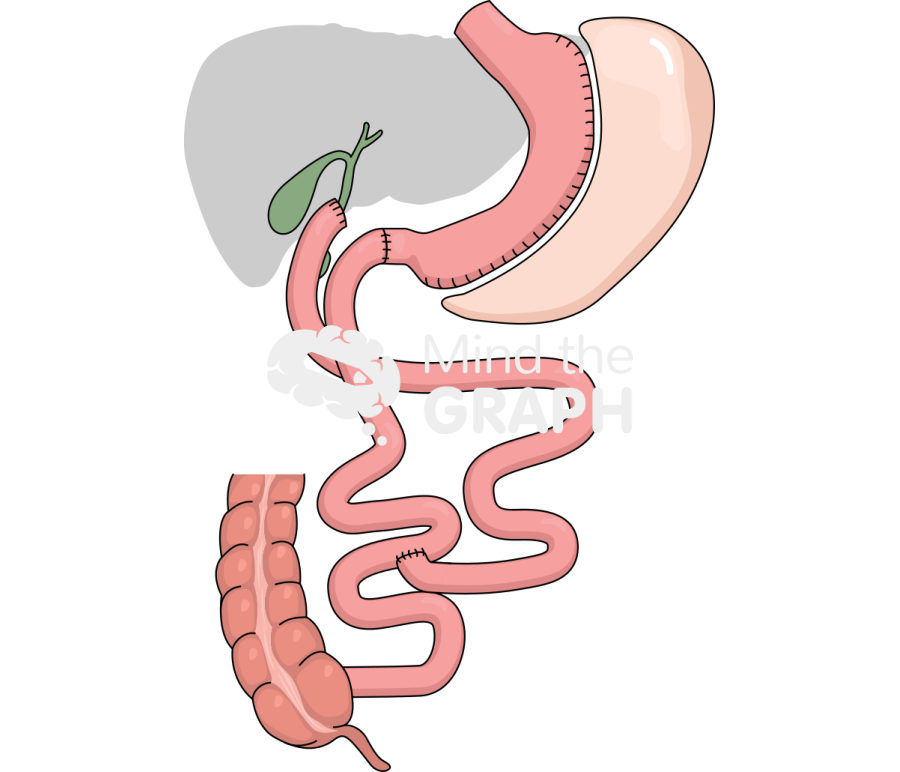Duodenal switch Icons, Symbols, Pictures, and Images