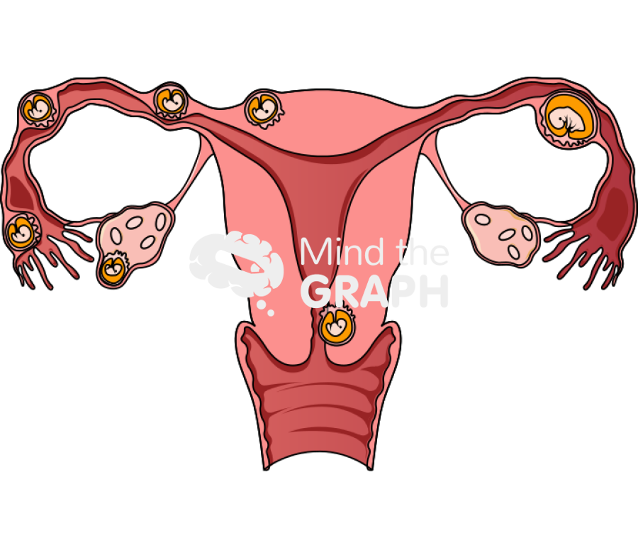 Ectopic pregnancies Icons, Symbols, Pictures, and Images