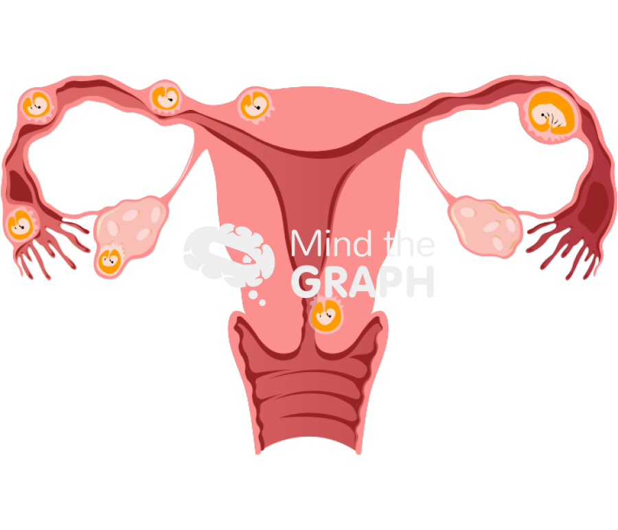 Ectopic pregnancies Icons, Symbols, Pictures, and Images