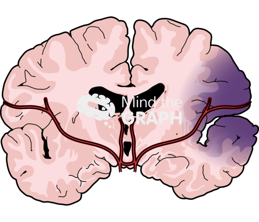 Human brain blood injury front cut 2 Icons, Symbols, Pictures, and Images