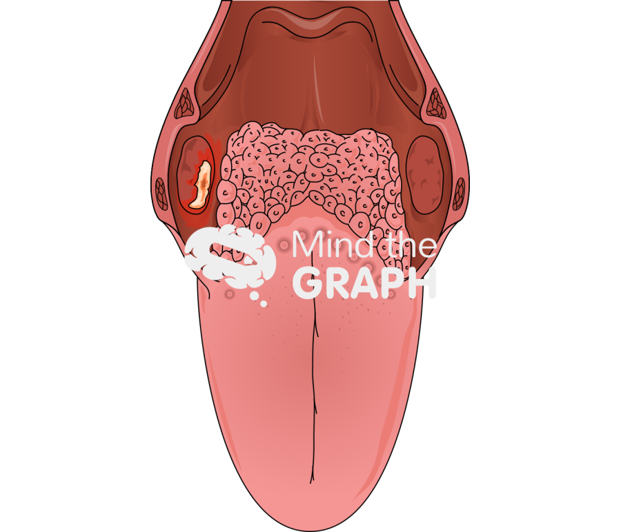 Tonsil cancer front Icons, Symbols, Pictures, and Images