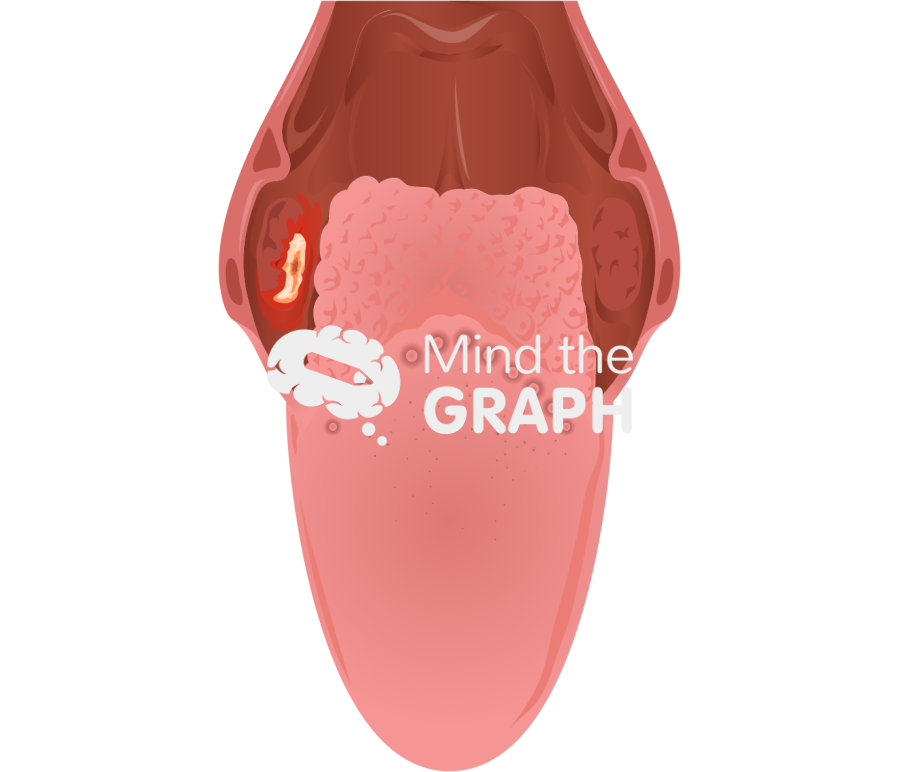 Tonsil cancer front Icons, Symbols, Pictures, and Images