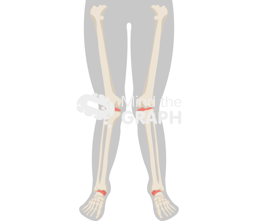 Valgus knees body Icons, Symbols, Pictures, and Images